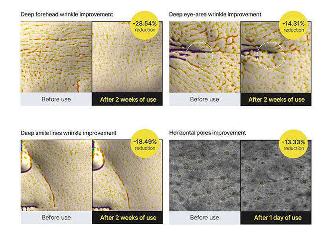 Before and after effects of a skincare product on deep wrinkles and aging pores with statistical reductions.